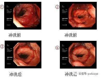 直肠癌术后多年瘘口出血该怎么办？还有办法治疗吗